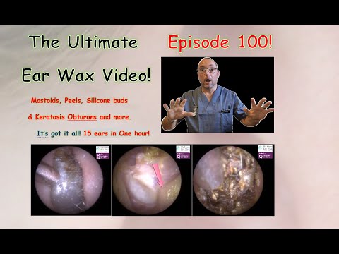 Видео: Лучшее видео о ушной сере! Выпуск 100 #ушнаясера #обтурирующийкератоз #грибок #ухо #удалениеушной...