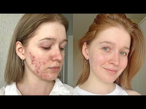 Видео: как избавиться от прыщей? моя история лечения акне