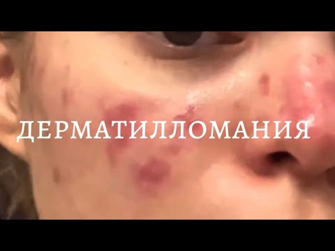 Видео: Дерматилломания ОКР Моя история