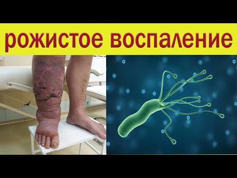 Видео: Копеечное средство от Рожистого воспаление. Комплексное лечение.