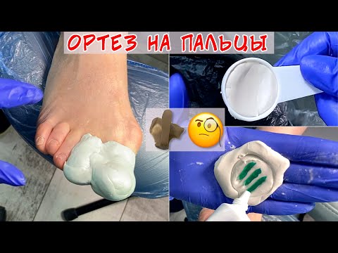Видео: Искривление пальцев на ногах / Изготовление ортеза на палец ноги