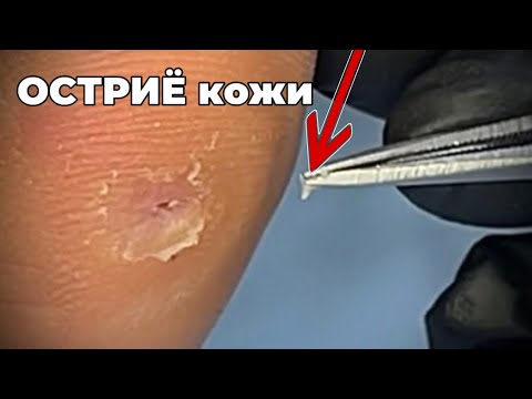Видео: Маленькая мозоль с глубоким стержнем внутри. 
