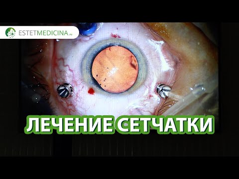 Видео: Хирургическое лечение отслоения СЕТЧАТКИ  👁️😮 Этап 2: удаление силикона