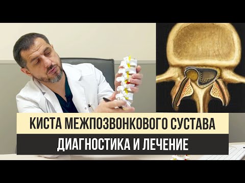 Видео: Параартикулярного киста фасеточного сустава позвоночника  Диагностика и лечение