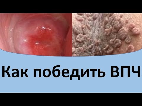 Видео: Как победить ВПЧ.  Папилломавирус лечение.