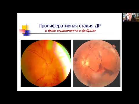 Видео: Диабет и Глаз. Диабетическая ретинопатия, Экгардт В.Ф., вебинар