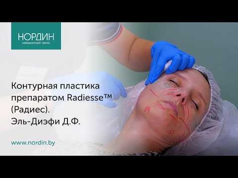 Видео: Контурная пластика препаратом Radiesse™ (Радиес)