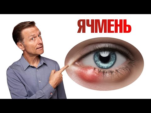 Видео: Как избавиться от ячменя на глазу раз и навсегда?👁