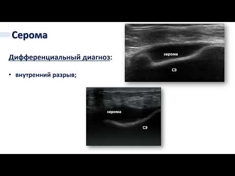 Видео: Особенности ультразвуковой диагностики имплант-ассоциированных лимфом молочных желез