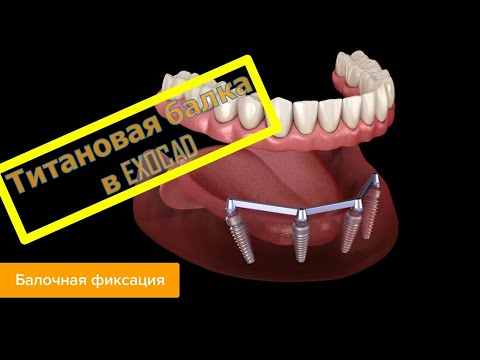 Видео: Изготовление титановой балки в EXOcad под съемный протез.