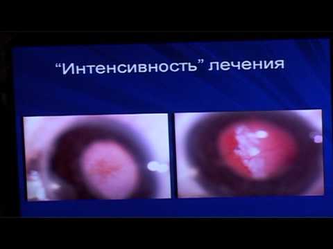Видео: Лечение ретинопатии недоношенных