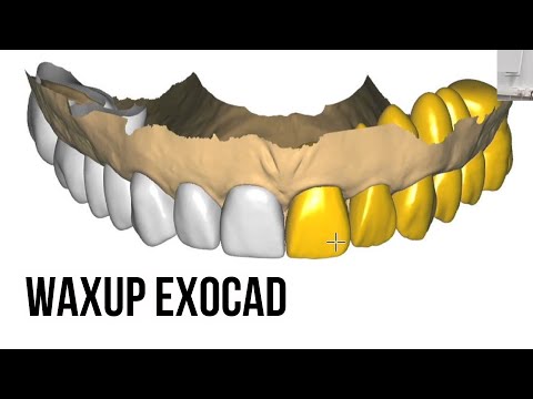 Видео: Wax up exocad разбор кейса. Exocad modelling