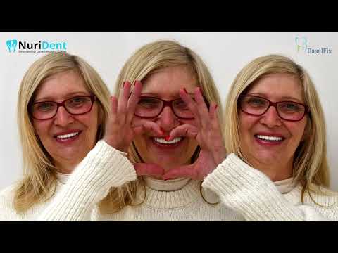 Видео: Албена спести⏰време със седация и върна качество на живот с модерните👄импланти BasalFix🦷на д-р Нури🥇