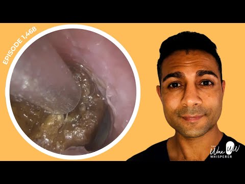 Видео: 1468 - Два случая удаления ушной серы, различающихся по консистенции и расположению в слуховом пр...