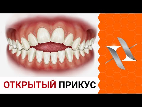 Видео: ОТКРЫТЫЙ прикус | Причины. Последствия. Лечение.