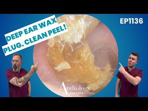 Видео: Глубокая ушная серная пробка удалена из узкого слухового прохода – удовлетворительный результат п...