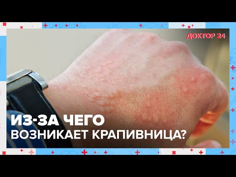 Видео: Из-за чего возникает КРАПИВНИЦА? | Доктор 24