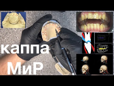 Видео: Лабораторные этапы изготовления каппы мир - Лечение НМР и ДВНЧС