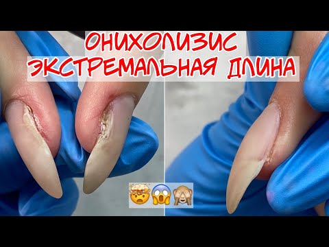 Видео: Онихолизис 🤯 Ногти от другого мастера 💅🏻 Работа над ошибками