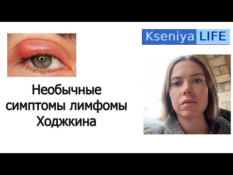 Видео: Странные предвестники лимфомы Ходжкина