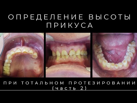 Видео: Антропометрические Методы Определения Высоты Прикуса (часть 2)