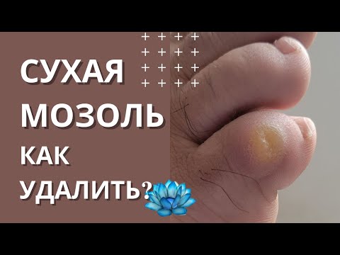 Видео: Сухая мозоль на ногах. Удаление сухих мозолей.