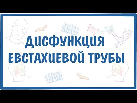 Видео: Дисфункция евстахиевой (слуховой) трубы (ДСТ) — причины, симптомы, патогенез, диагностика, лечение