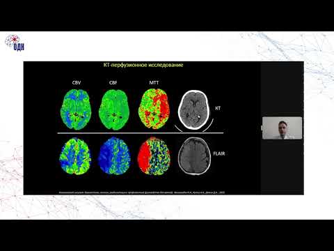 Видео: Кулеш - Экстренная нейровизуализация у больных инсультом
