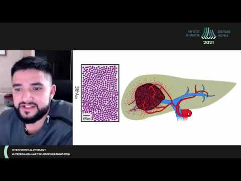 Видео: Радиоэмболизация печени микросферами отечественного производства: первые результаты (Петросян А.П.)