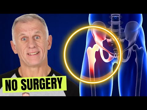 Видео: Что мы узнали из 1000 случаев артрита тазобедренного сустава