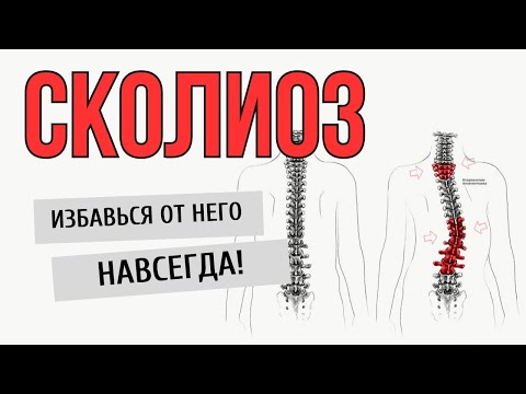 Видео: Избавься от СКОЛИОЗА❗️ Тренировка при сколиозе ЛУЧШИМИ методами❗️