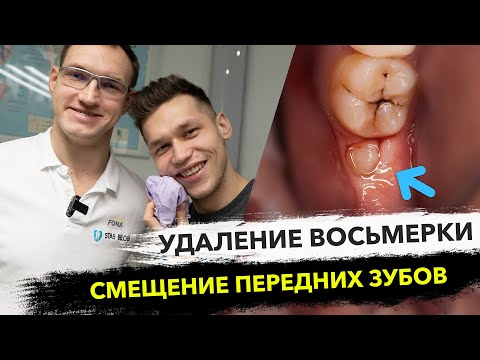 Видео: Удаление зуба мудрости и что будет после удаления зуба мудрости? УЛЬЯНОВСК 2019