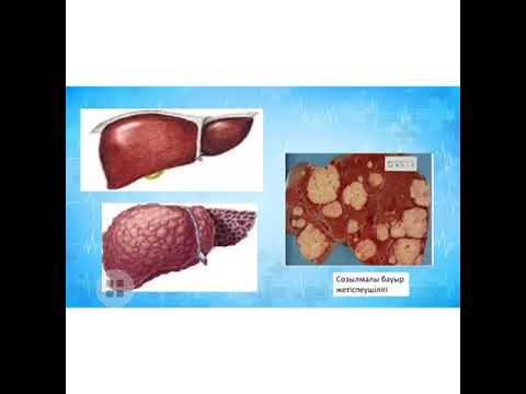 Видео: Тақырыбы: Созылмалы бауыр жетіспеушілігі. Оқытушы: Конирова С.К.