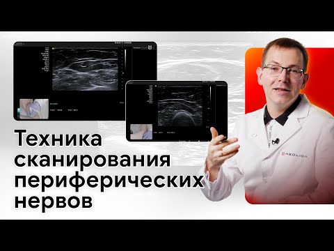 Видео: УЗИ периферических нервов верхних конечностей на Siemens NX3 Elite