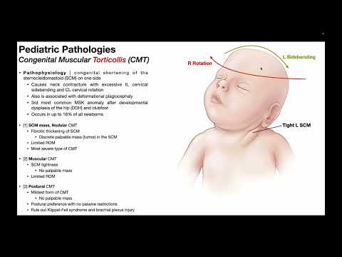 Видео: Кривошея → Механизм, патофизиология и последствия у младенцев