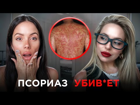 Видео: Псориаз - самый загадочный и непредсказуемый диагноз. Но так ли он безопасен на самом деле?