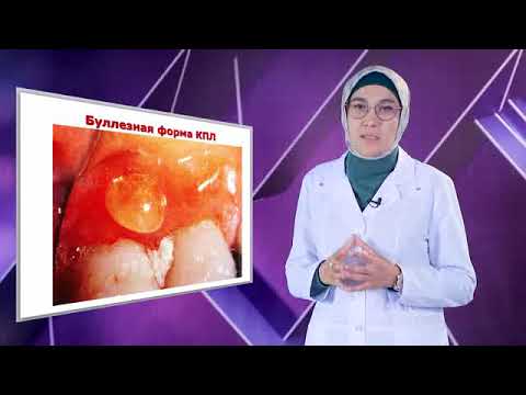 Видео: Красный плоский лишай полости рта: Клиника, диагностика , лечение