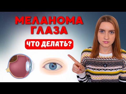 Видео: КАК ЛЕЧИТЬ МЕЛАНОМУ ГЛАЗА ПРАВИЛЬНО? #меднавигатор #онкология #онколог #рак #протоннаятерапия