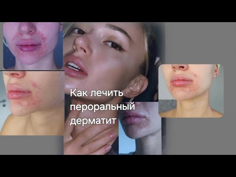 Видео: ПЕРОРАЛЬНЫЙ ДЕРМАТИТ МОЙ ОПЫТ ЛЕЧЕНИЯ