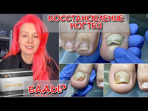 Видео: Травмированые ногти / Наш опыт приема БАДа "Синтезит" / Восстановление ногтей