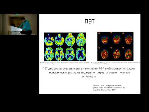 Видео: Сложные вопросы ведения пациентов с эпилептическим статусом Подлепич В.В.