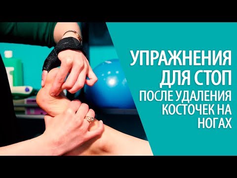 Видео: УПРАЖНЕНИЯ ДЛЯ СТОП после удаления косточек на ногах HALLUX VALGUS Алексей Олейник