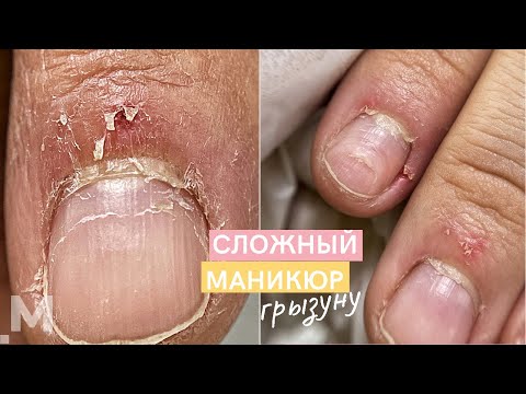 Видео: КРОВАВЫЕ заусенцы и ЖЕСТКАЯ НАЛИПШАЯ кутикула 🍖 Маникюр ГРЫЗУНУ. Наращивание сгрызенных ногтей