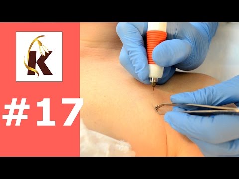 Видео: Электрокоагуляция- Как убрать родинки, бородавки, папилломы, рубиновые точки, сосуды (купероз)# 17