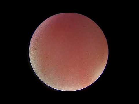 Видео: Контактная уретеролитотрипсия по поводу камня мочеточника