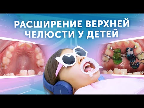 Видео: Расширение верхней челюсти у детей | Аппарат Haas