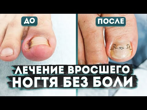 Видео: ВРОСШИЙ НОГОТЬ. Простой Способ Вылечить Вросший Ноготь Без Боли | Причины вросшего ногтя | MEDPED