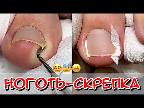 Видео: Ноготь - скрепка / Вросший ноготь / Врос на ноге / Что делать / Вросший ноготь на ноге