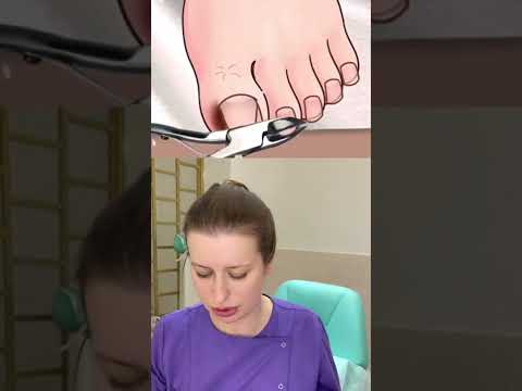 Видео: А у вас есть вросшие ногти?🤔