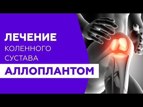 Видео: Лечение коленного сустава Аллоплантом